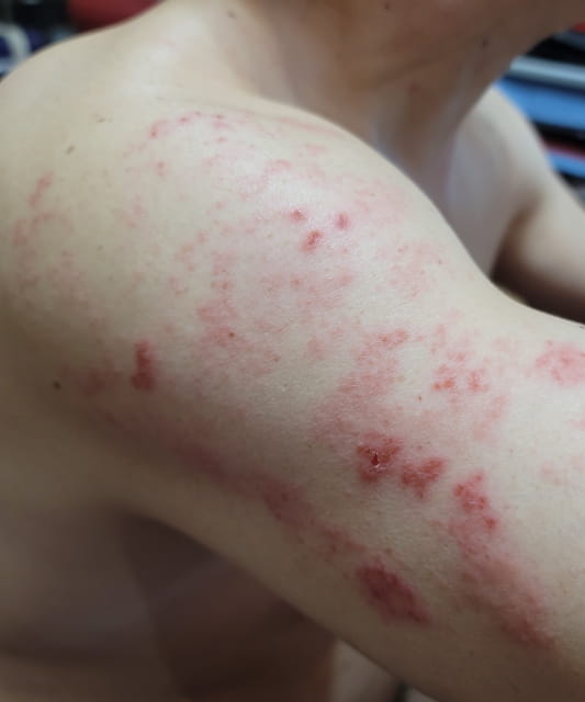 初期症状の見た目・画像の特徴