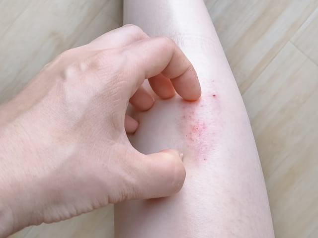 帯状疱疹とよく似た皮膚症状との見分け方