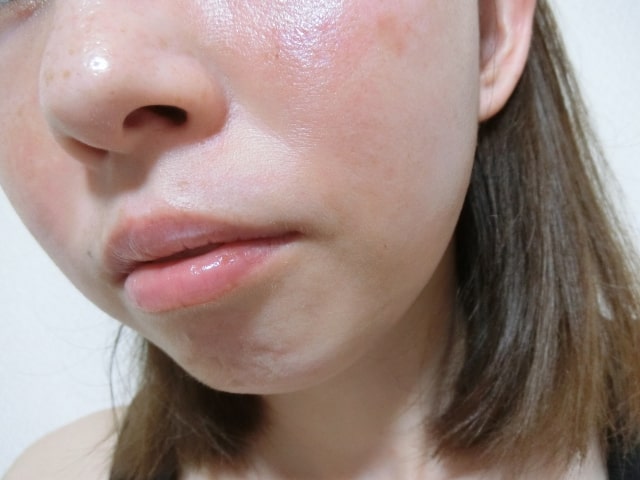 赤ら顔に有効な治療法と皮膚ケア